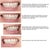 The email I sent my ortho included this to explain my issues with the results. You can clearly see what's wrong.
