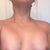 DAY POST OP