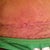 scar is healing perfect this is the 2 week mark I can only imagine how unnoticable it will be at 2 years
