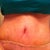 My belly button that's swollen shut almost.  Not sure what it's doing actually.