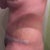 Day 16 sorry  for all the wrinkles just woke up and I wear all my compression to bed