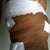 one week postop side