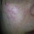 12 hours after 1st IPL procedure. Right side of face, cheek area - my scar isn't too noticeable here but it's there (kind of where the shine is) right under my eye on my cheek. My cheeks seem to be sensitive.