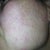 12 hours after 1st IPL procedure. Left cheek, sun damage probably from driving. Slightly darker than it was before.