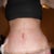 2 weeks post op