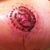 Left nipple graft 18 days post op. top layer of skin is peeling.