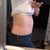 Day of Upper stomach: You can see the swelling.