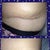See...the pleating really does to down. Look how swollen I was, but didn't feel so at the time, crazy!