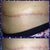This side is much flatter even tho it's not translating on pic. The internal stitches are finally dissolving.