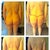 Back Pre-op, 4 days post, 11 days post, 25 days post