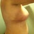 Post Op Day 19--second day without tape on incisions