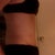 Side view at 6 weeks.  The swelling has gone down over the pubis area and my stomach is much flatter than it was 2.5 weeks ago!
