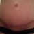 7 weeks post op..scar is VERY red but laying flat! Can't wait for bikini belly!!