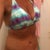 Six weeks post op