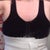Post op day 8 with compression garment on