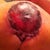 Close up of right nipple w/ Issue.  4 Days Post Op