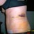 Day #5 post op tummy tuck side view