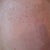 Right side 2 hours after treatment