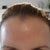 Forehead 2 hours after treatment