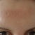 Forehead day 3