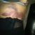 first day of surgery, left rib cage