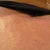 Seroma, trying to show you guys it is that bump it is hard as rock, that is what he sticks the needle in at my incsion and drains, he also has been taking a little fluid out of my belly