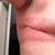Scar revision surgery.  Had allergic reaction to steri strips. Other than that, so far so good.