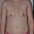 1 day post op
