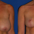 5 months post op.