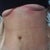 4 days po -new tummy and belly button! It's swollen and it still looks better than my before pics!!