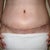 2 weeks post op