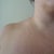 Shoulder Dents