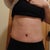 2 weeks post op (Scabs in belly button)