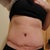 2 weeks post op scar - ew - doc said it should smooth out nicely though
