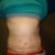 18 Days PO.  The swelling has gone down quite a bit in just 4 days!