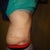 18 Days PO. You can see the swelling in my back and love handles right here, but hey!  Look at that flat tummy, Jack! :)
