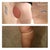 Top: 1 month 4 days post op.
Bottom: pre-post