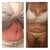 Top: 1 month 4 days post op.
Bottom: pre-post