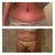 Top: 1 month 4 days post op.
Bottom: pre-post