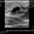 ultrasound of right breast with infection