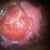 right breast infected