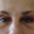 day three of surgery.Can see upper crease and fullness