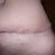 14 weeks 2 days PO .......dog ear....looks like a nipple on my hip!