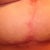 right breast scar