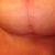 left breast scar