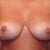 front view of breast
