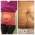 Before my hernia was removed and after it was removed. You can see the lump on my belly button that was the hernia and now I actually have a belly button hole underneath my bad skin. Looking forward for Dra. Robles to fix my tummy and make me back how I was before my kids.