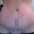3 weeks po. Scar up close...has tape on it though. But it really is light and teeny!!