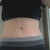 13 days, covered with yoga pants and still very swollen. I do like my belly button!