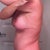 6 months post op - side view